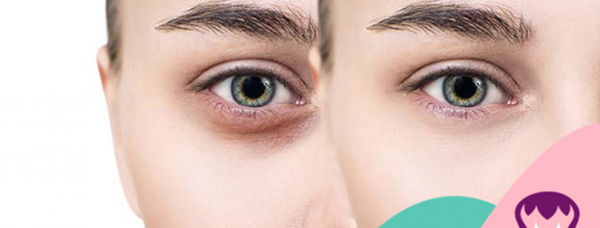 درمان سیاهی و گودی زیر چشم