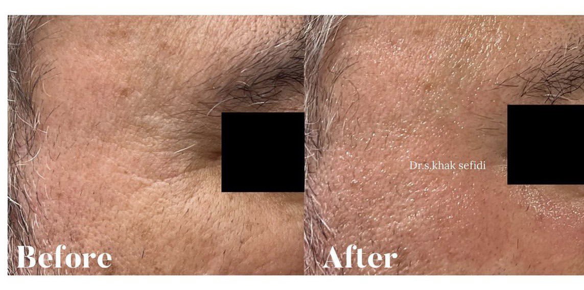 جوانسازی دور چشم