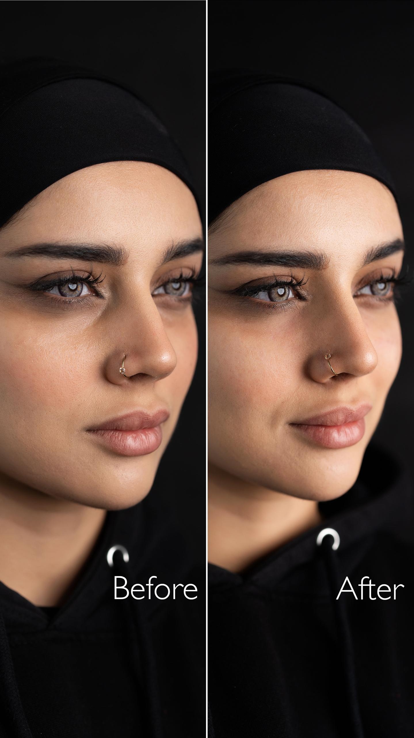 فیلر زیر چشم